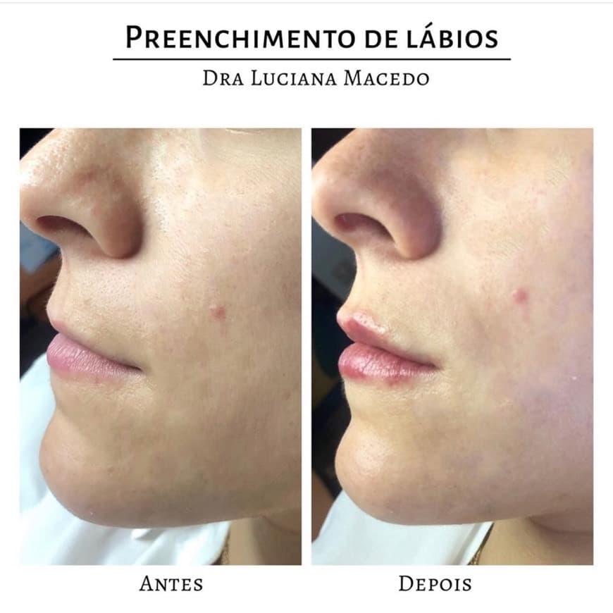 Product Preenchimento de lábios com Juvederm Ultra Smile 