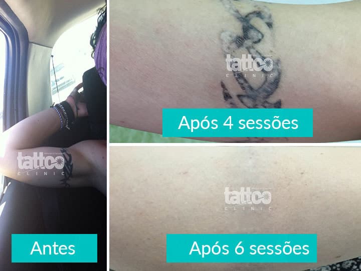 Lugar Tattoo Clinic - Remoção de Tatuagem - Faro