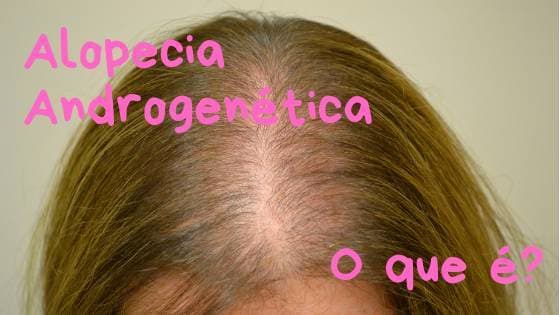 Moda Alopecia Androgenética: o que é?