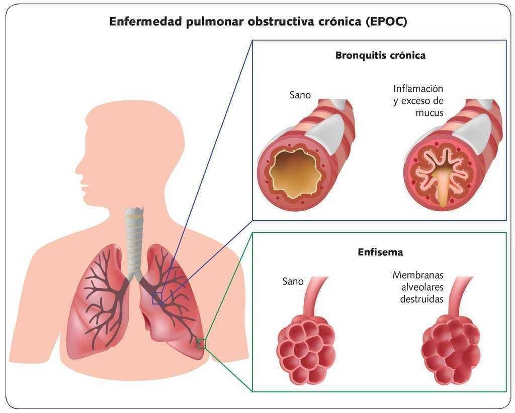 Fashion Enfermedad de obstrucción pulmonar crónica