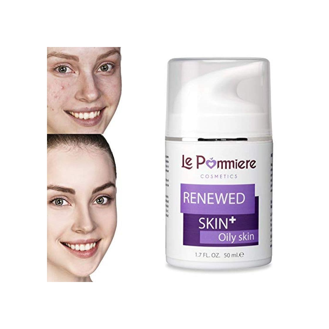 Belleza Le Pommiere Acné Gel 50ml, Ayuda a Remover Espinillas, Granos en Cara