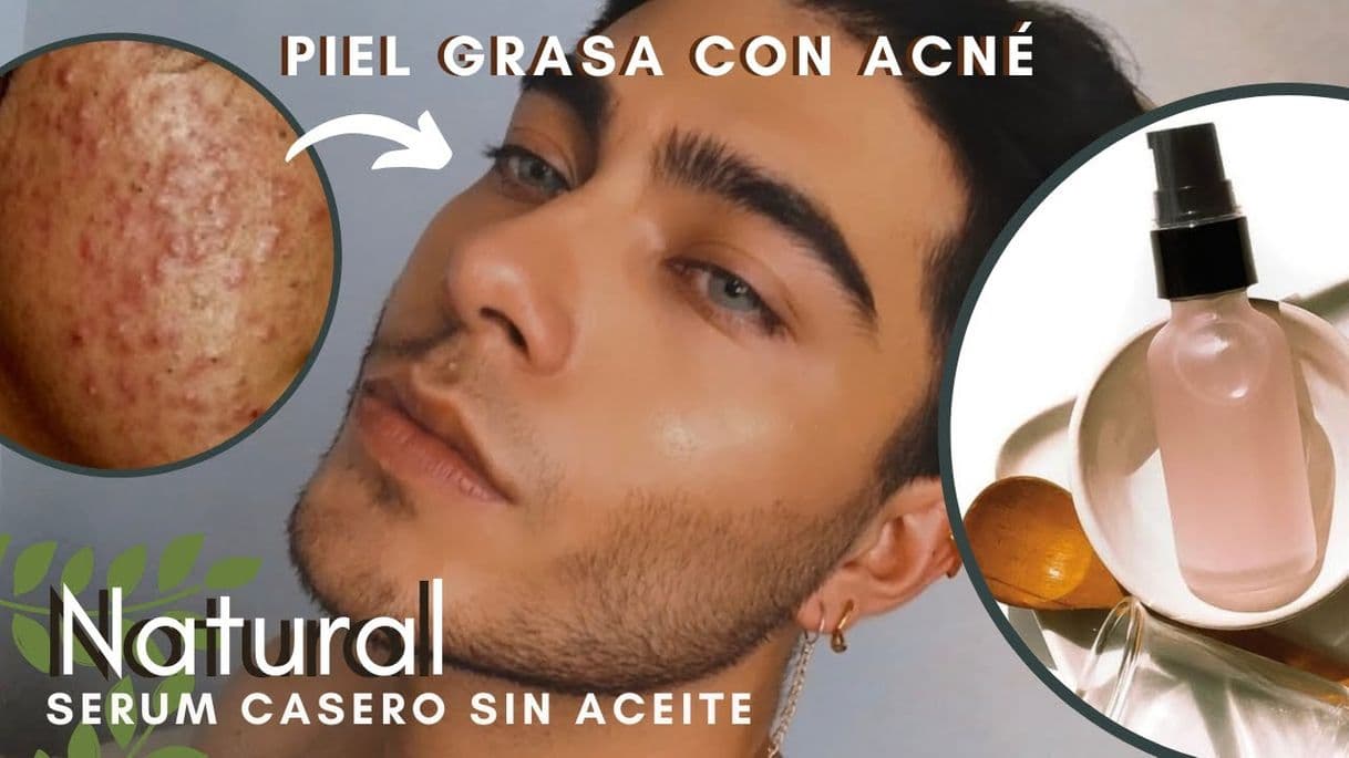 Moda Serúm Casero para PIEL GRASA Y CON ACNÉ 100%Natural y ...