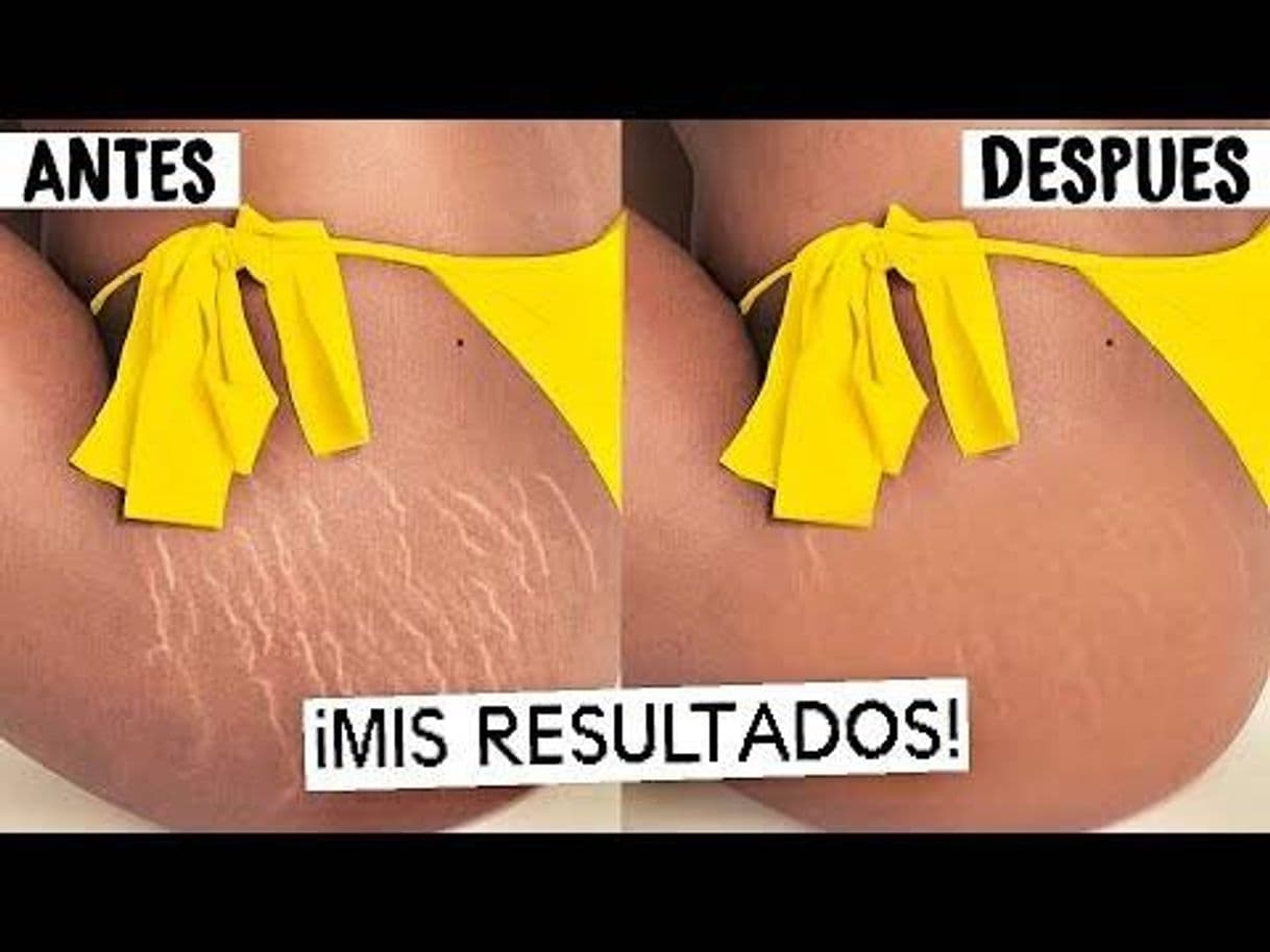 Fashion Como eliminar estrías en semanas 