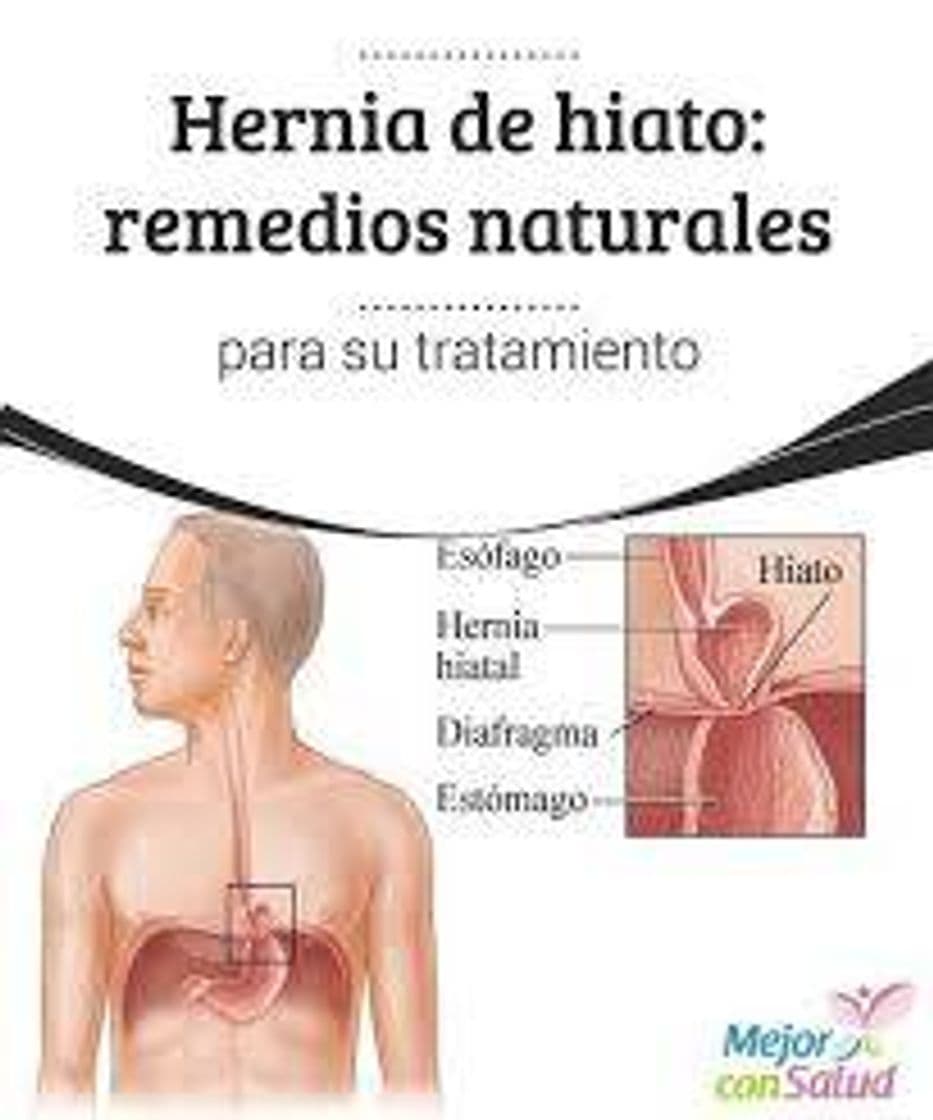 Fashion Hernia de hiato. 10 Remedios y ejercicios para su tratamiento ...