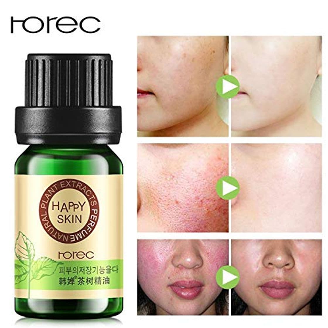 Producto ROREC 100% Tea Tree Compound Essential Oil Moisturizer Faical Oil-control Acne Treatment