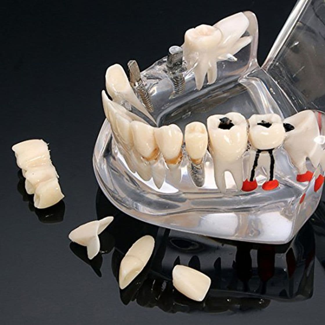 Producto Modelo de dientes de enfermedad de implante dental con puente de restauración Modelo de ortodoncia de maloclusión para ciencia médica dental