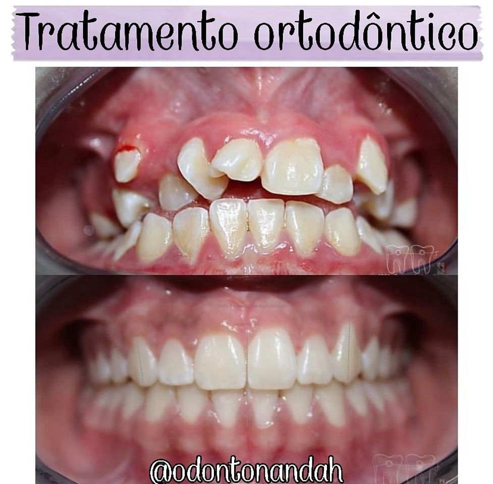 Fashion Tratamento ortodôntico✨