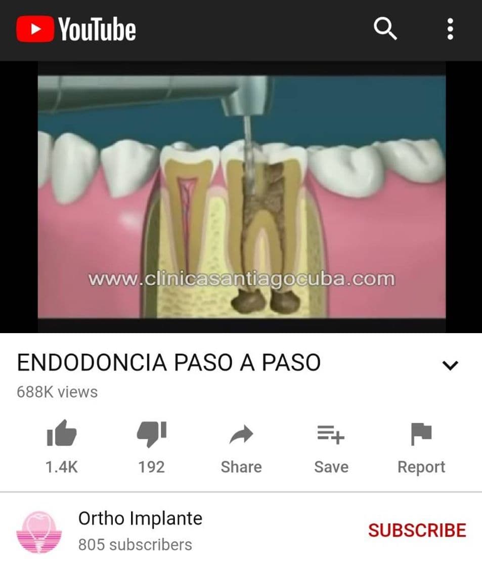 Moda Endodoncia paso a paso 