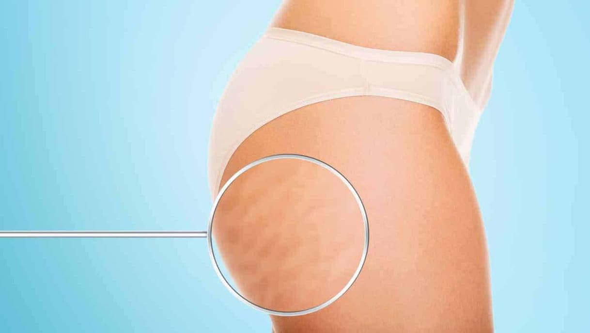 Fashion COMO QUITAR LA CELULITIS DE LAS PIERNAS DE FORMA NATURAL