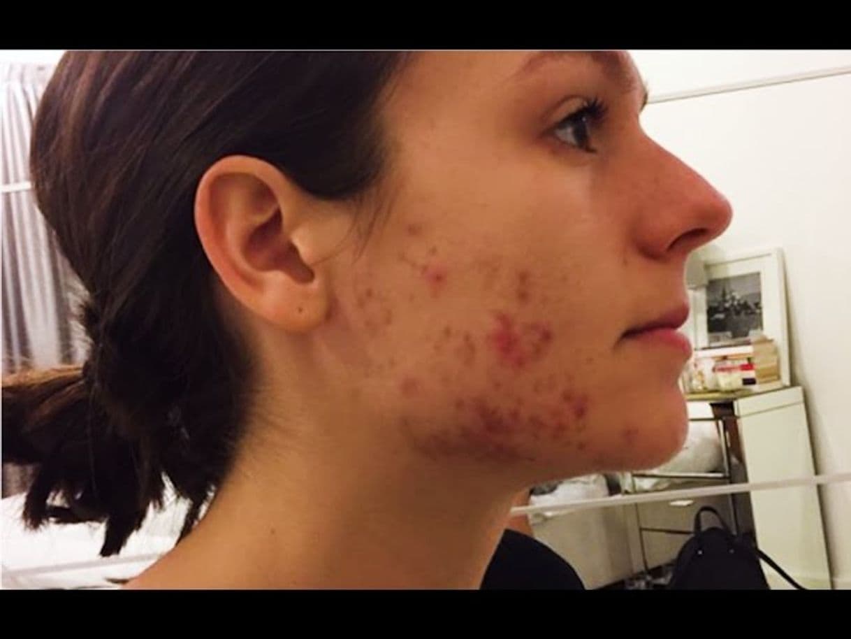 Moda Como eliminar el acne - YouTube