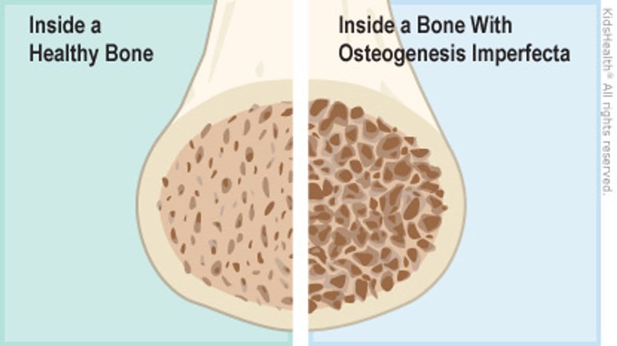 Fashion Osteogenesis imperfecta